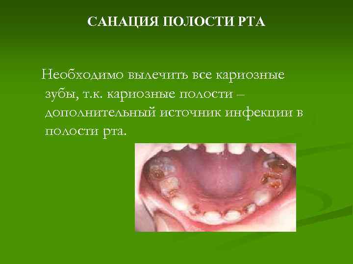 САНАЦИЯ ПОЛОСТИ РТА Необходимо вылечить все кариозные зубы, т. к. кариозные полости – дополнительный