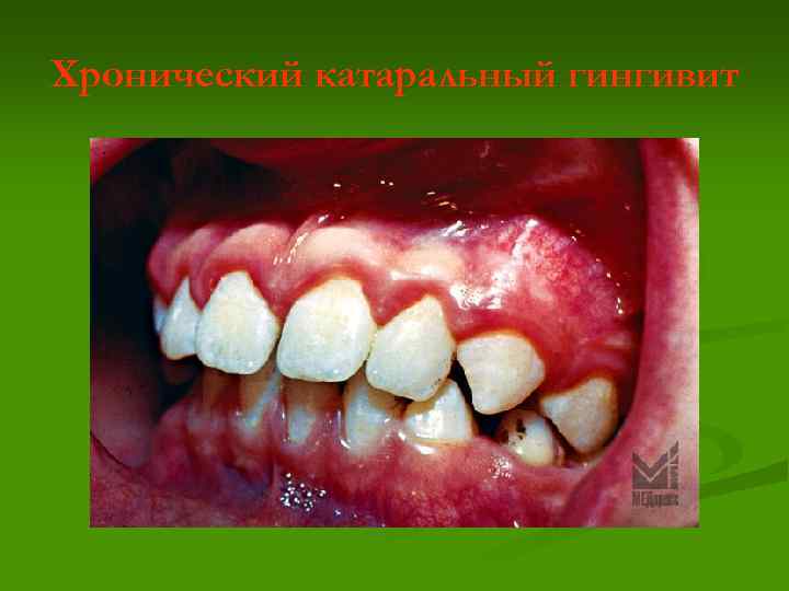 Хронический катаральный гингивит 