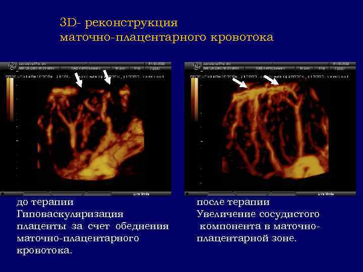 3 D- реконструкция маточно-плацентарного кровотока до терапии Гиповаскуляризация плаценты за счет обеднения маточно-плацентарного кровотока.