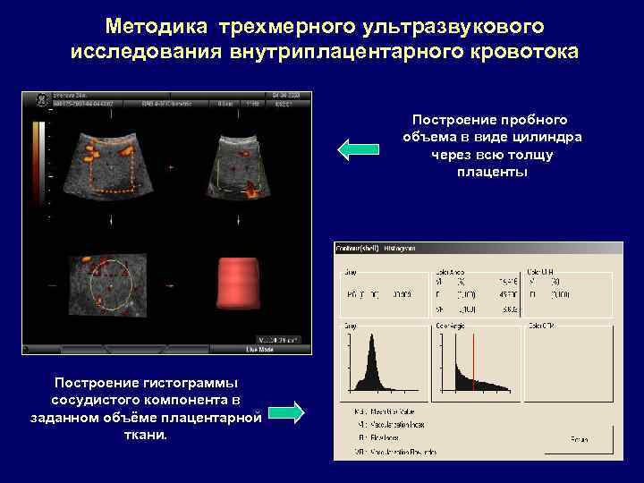 Методика трехмерного ультразвукового исследования внутриплацентарного кровотока Построение пробного объема в виде цилиндра через всю