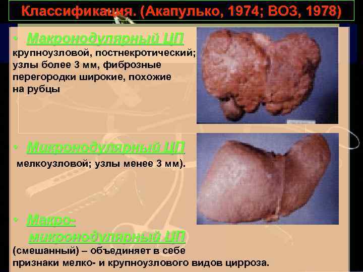 Классификация. (Акапулько, 1974; ВОЗ, 1978) • Макронодулярный ЦП крупноузловой, постнекротический; узлы более 3 мм,