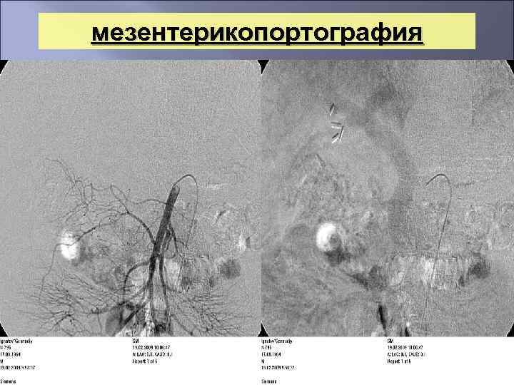 мезентерикопортография 