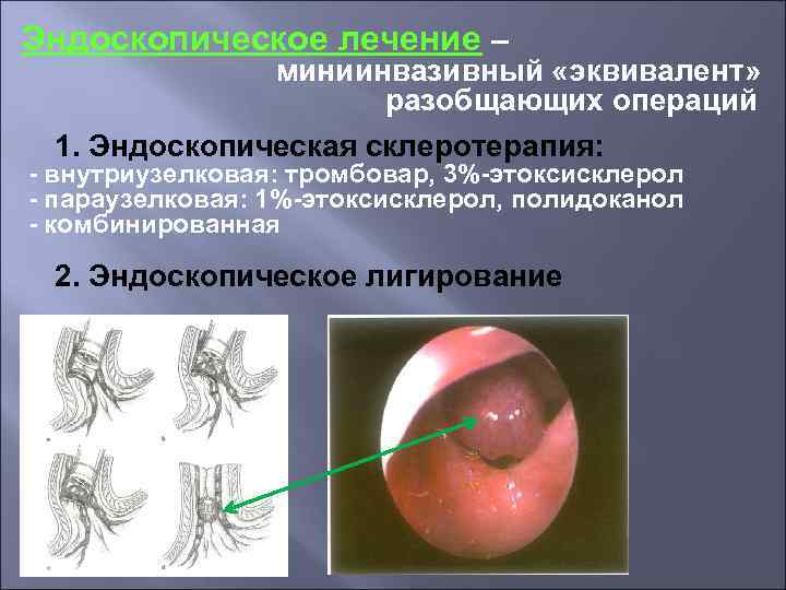 Эндоскопическое лечение – миниинвазивный «эквивалент» разобщающих операций 1. Эндоскопическая склеротерапия: - внутриузелковая: тромбовар, 3%-этоксисклерол