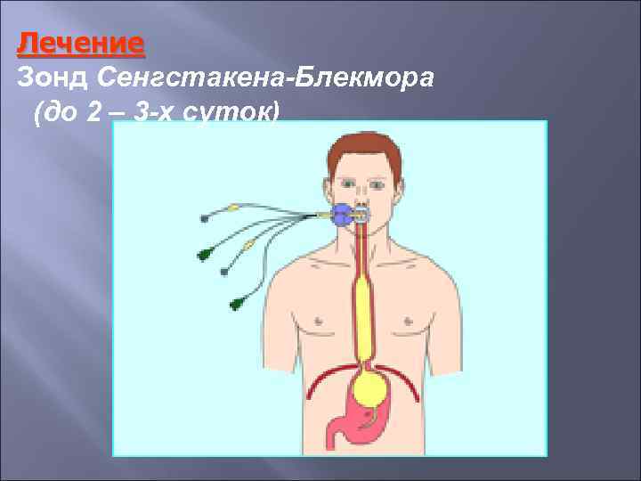 Лечение Зонд Сенгстакена-Блекмора (до 2 – 3 -х суток) 