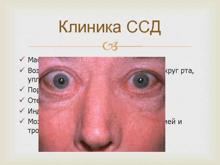 Клиника ССД ü Маскообразность лица ü Возможны кисетообразные морщины вокруг рта, уплотнение и натяжение