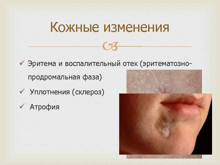 Кожные изменения ü Эритема и воспалительный отек (эритематознопродромальная фаза) ü Уплотнения (склероз) ü Атрофия