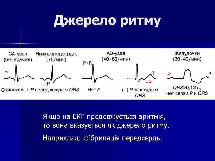 Джерело ритму Якщо на ЕКГ продовжується аритмія, то вона вказується як джерело ритму. Наприклад: