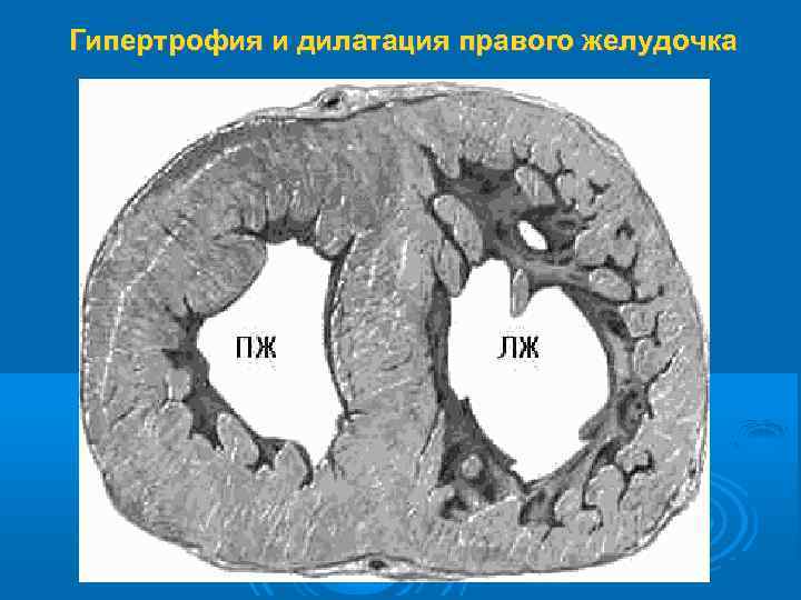 Гипертрофия и дилатация правого желудочка 