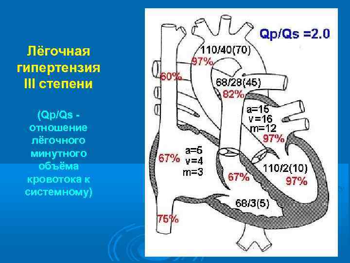 Лёгочная гипертензия III степени (Qp/Qs - отношение лёгочного минутного объёма кровотока к системному) 