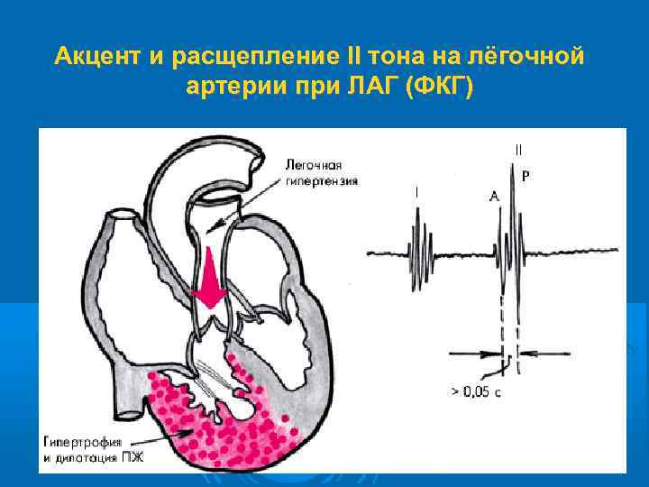 Акцент и расщепление II тона на лёгочной артерии при ЛАГ (ФКГ) 