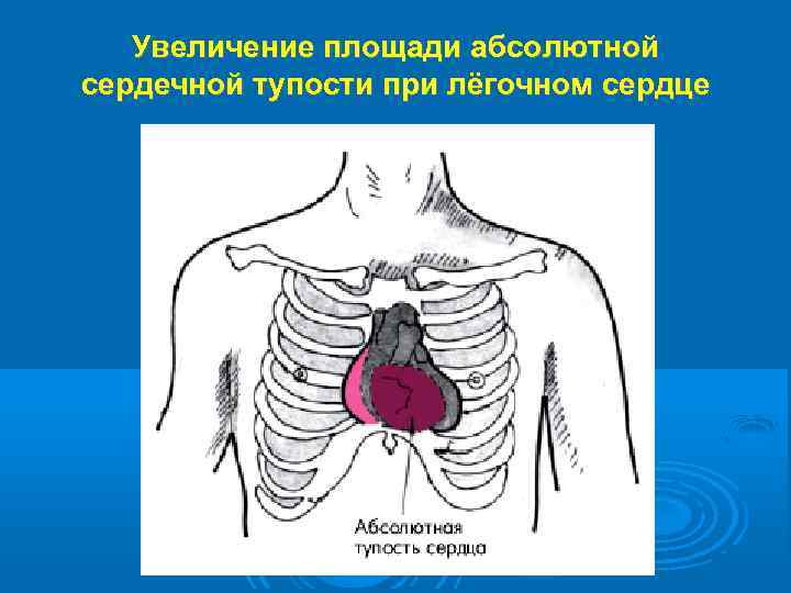 Увеличение площади абсолютной сердечной тупости при лёгочном сердце 