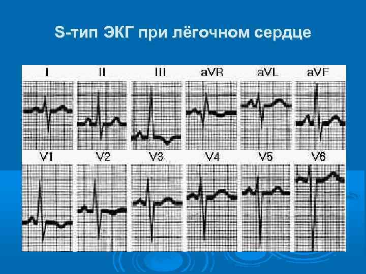 S-тип ЭКГ при лёгочном сердце 