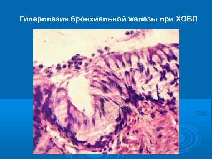 Гиперплазия бронхиальной железы при ХОБЛ 