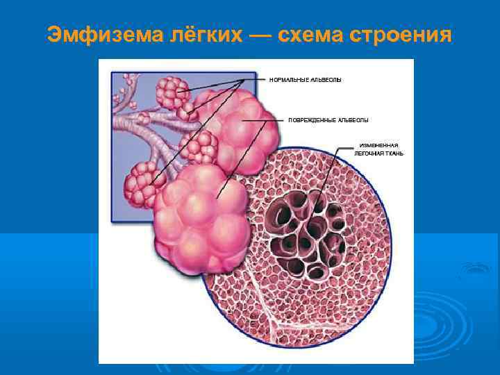Эмфизема лёгких — схема строения 