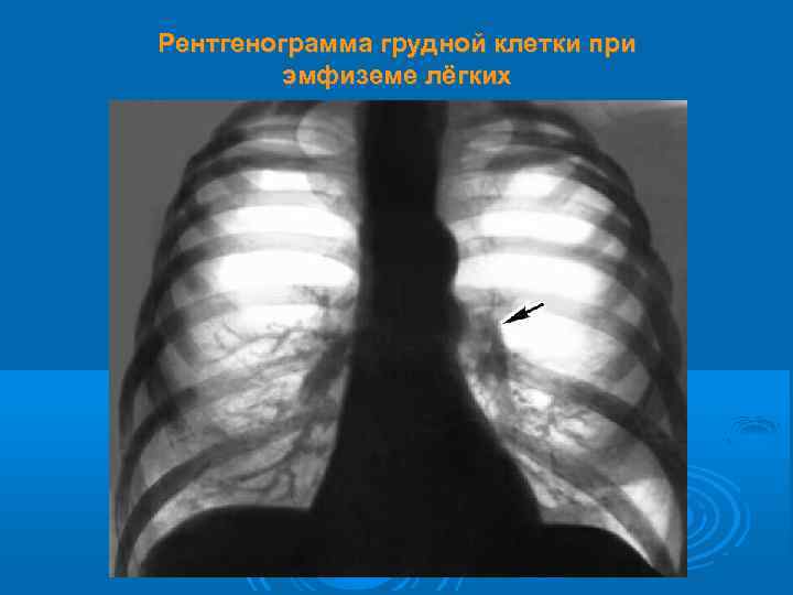 Рентгенограмма грудной клетки при эмфиземе лёгких 