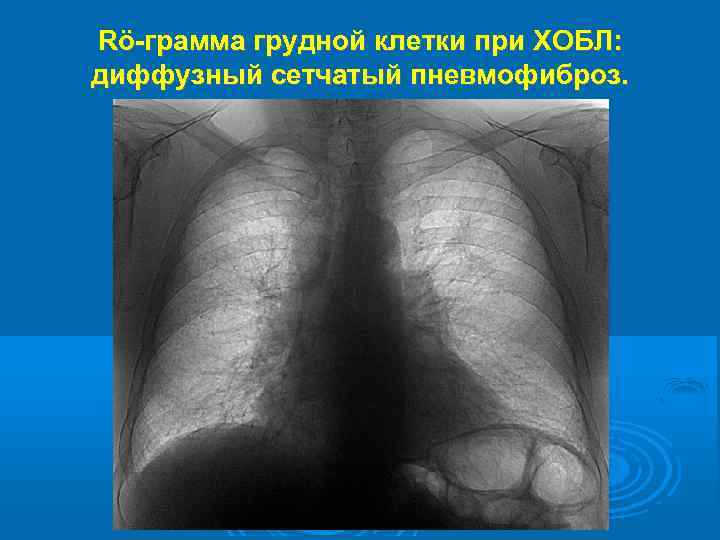 Rö-грамма грудной клетки при ХОБЛ: диффузный сетчатый пневмофиброз. 