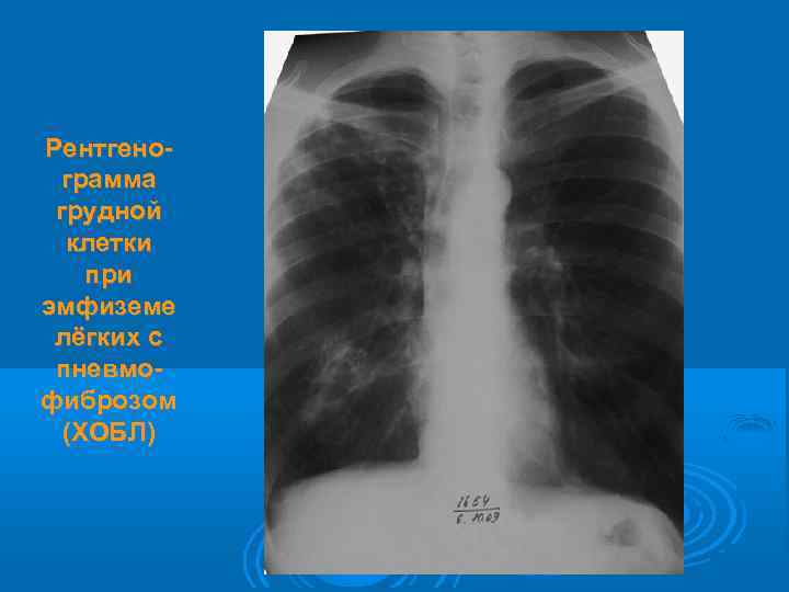 Рентгенограмма грудной клетки при эмфиземе лёгких с пневмофиброзом (ХОБЛ) 