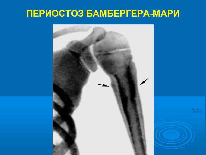 ПЕРИОСТОЗ БАМБЕРГЕРА-МАРИ 