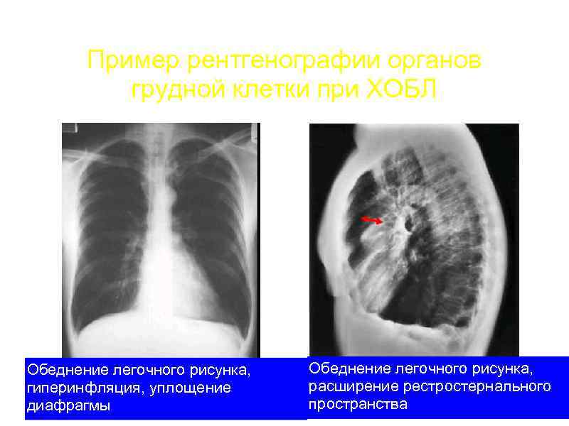 Обеднение легочного рисунка