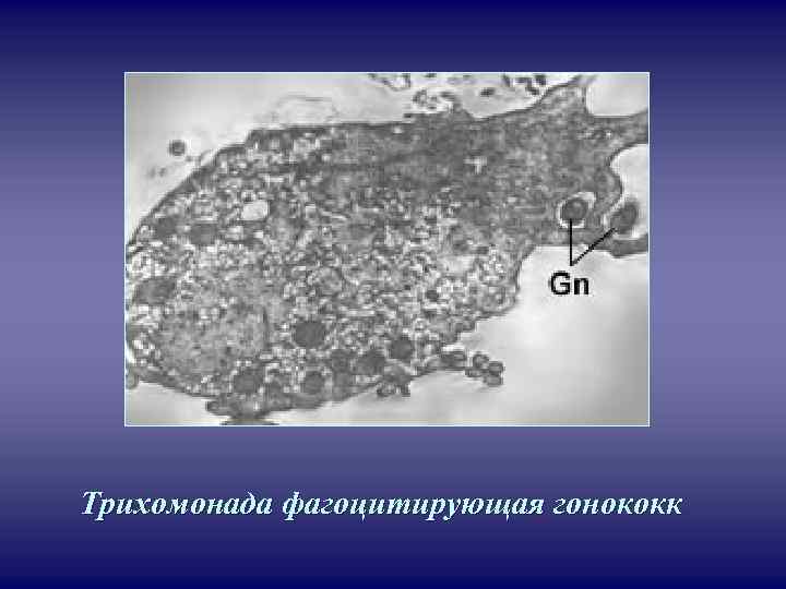  Трихомонада фагоцитирующая гонококк 