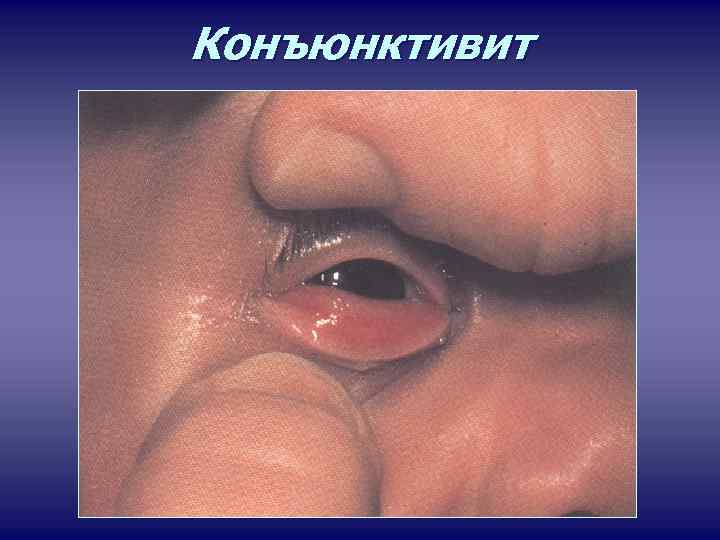 Конъюнктивит 