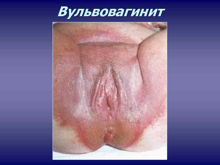 Вульвовагинит 