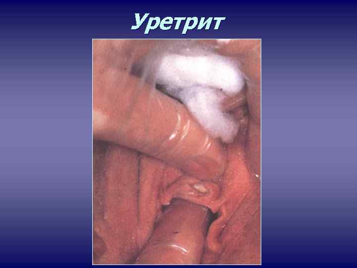 Уретрит 