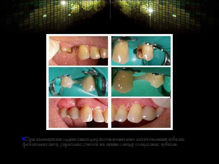 n. При замещении одиночных дефектов возможно изготовления зуба из фотокомпозита, укрепляющегося на шине между