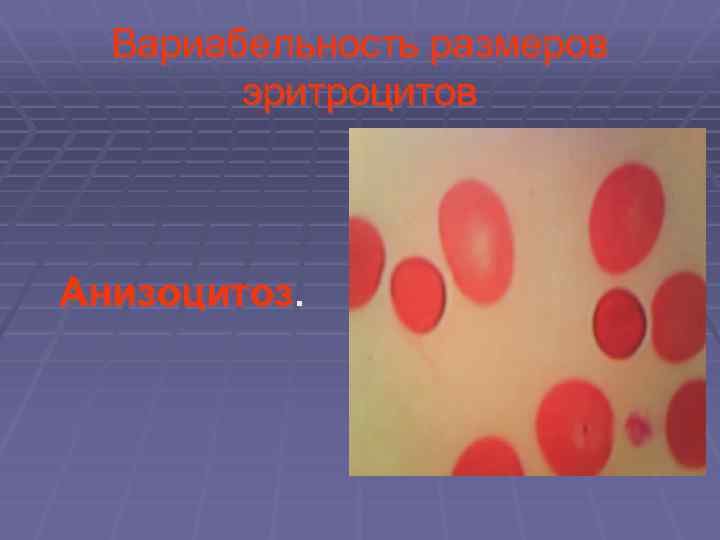 Вариабельность размеров эритроцитов Анизоцитоз. 