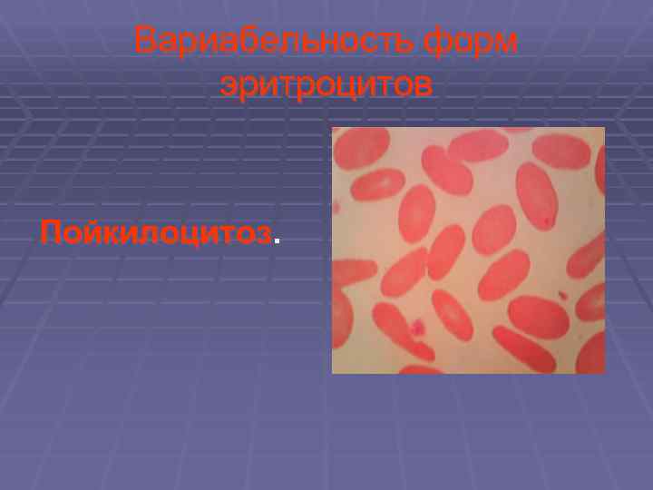 Вариабельность форм эритроцитов Пойкилоцитоз. 