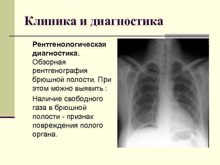 Клиника и диагностика Рентгенологическая диагностика. Обзорная рентгенография брюшной полости. При этом можно выявить :