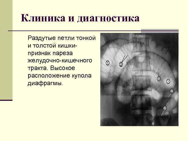 Клиника и диагностика Раздутые петли тонкой и толстой кишкипризнак пареза желудочно-кишечного тракта. Высокое расположение