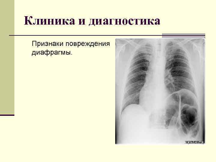 Клиника и диагностика Признаки повреждения диафрагмы. 