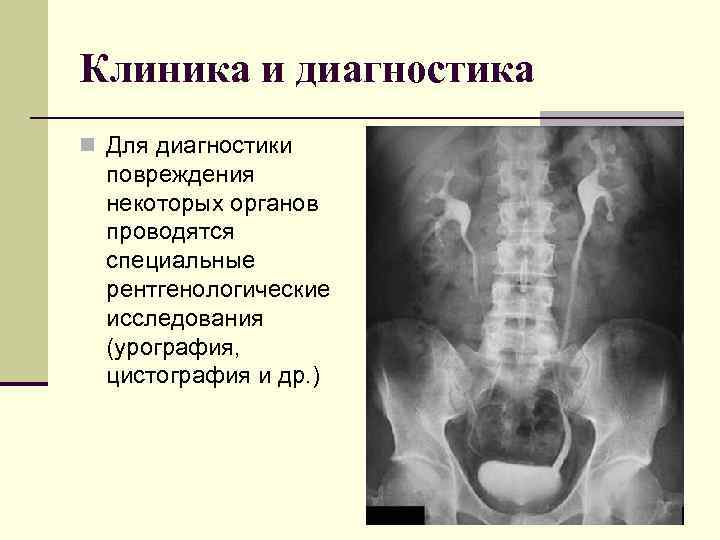 Клиника и диагностика n Для диагностики повреждения некоторых органов проводятся специальные рентгенологические исследования (урография,