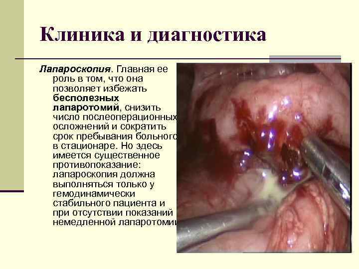 Клиника и диагностика Лапароскопия. Главная ее роль в том, что она позволяет избежать бесполезных