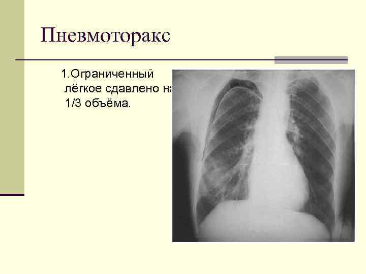 Пневмоторакс 1. Ограниченный лёгкое сдавлено на 1/3 объёма. 