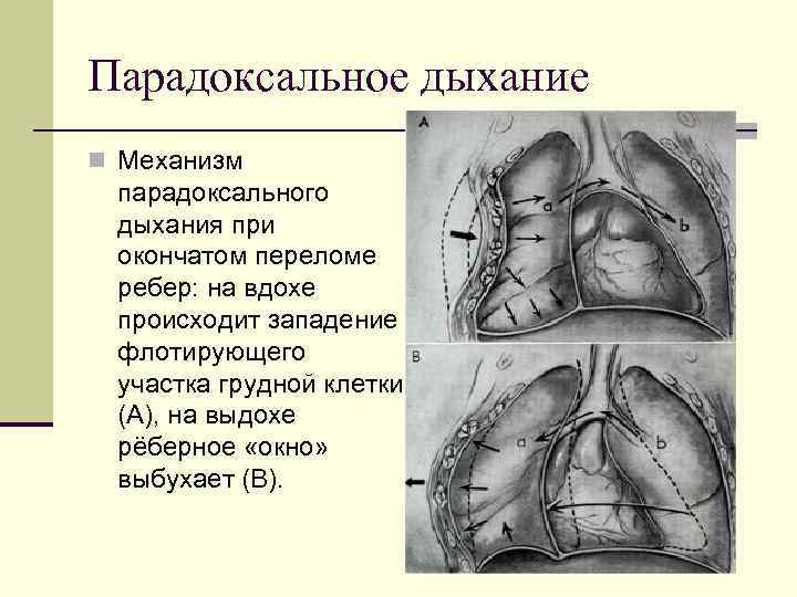 Парадоксальное дыхание n Механизм парадоксального дыхания при окончатом переломе ребер: на вдохе происходит западение