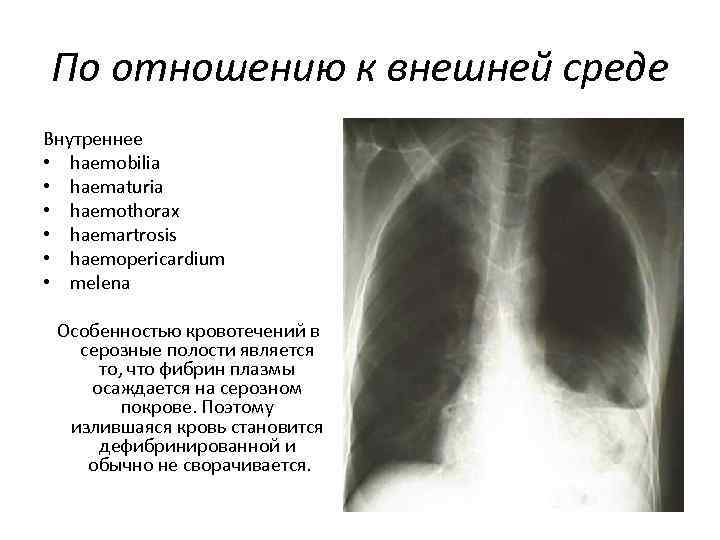 По отношению к внешней среде Внутреннее • haemobilia • haematuria • haemothorax • haemartrosis