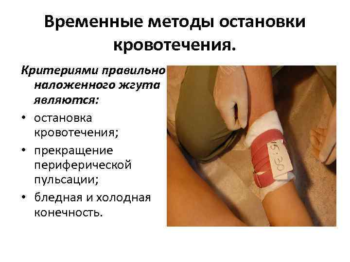 Временные методы остановки кровотечения. Критериями правильно наложенного жгута являются: • остановка кровотечения; • прекращение