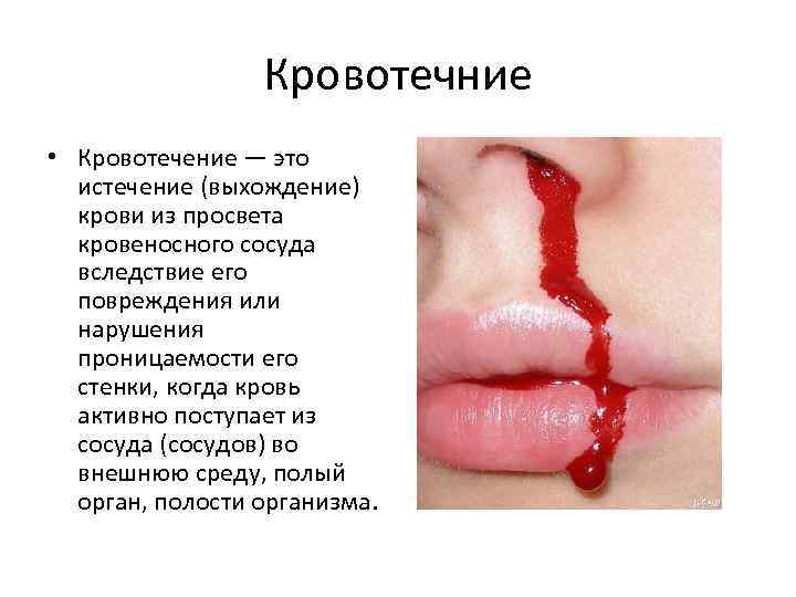 Кровотечние • Кровотечение — это истечение (выхождение) крови из просвета кровеносного сосуда вследствие его