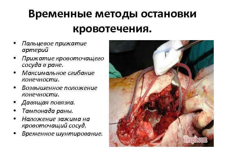 Временные методы остановки кровотечения. • Пальцевое прижатие артерий • Прижатие кровоточащего сосуда в ране.