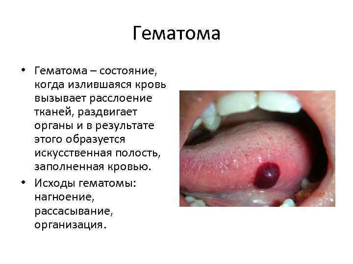 Гематома • Гематома – состояние, когда излившаяся кровь вызывает расслоение тканей, раздвигает органы и