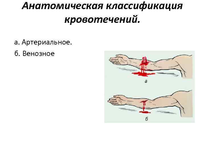 Анатомическая классификация кровотечений. а. Артериальное. б. Венозное 
