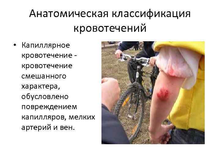 Анатомическая классификация кровотечений • Капиллярное кровотечение смешанного характера, обусловлено повреждением капилляров, мелких артерий и