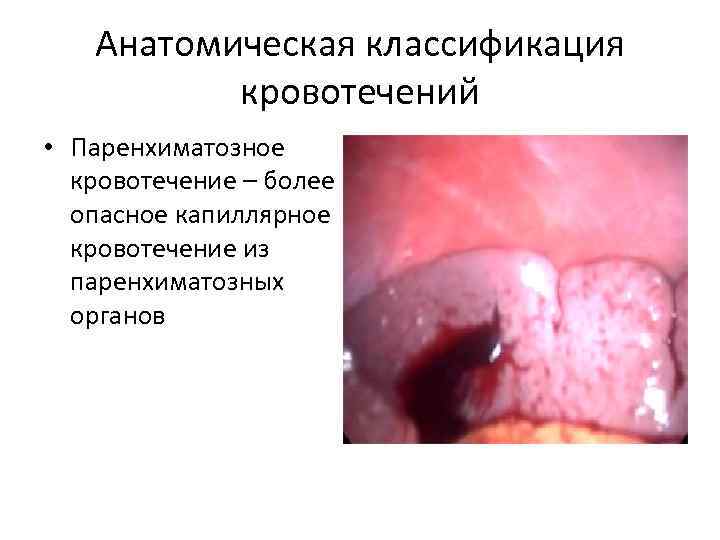 Анатомическая классификация кровотечений • Паренхиматозное кровотечение – более опасное капиллярное кровотечение из паренхиматозных органов