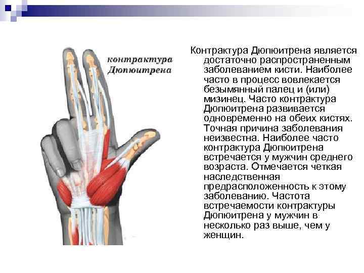 Контрактура Дюпюитрена является достаточно распространенным заболеванием кисти. Наиболее часто в процесс вовлекается безымянный палец
