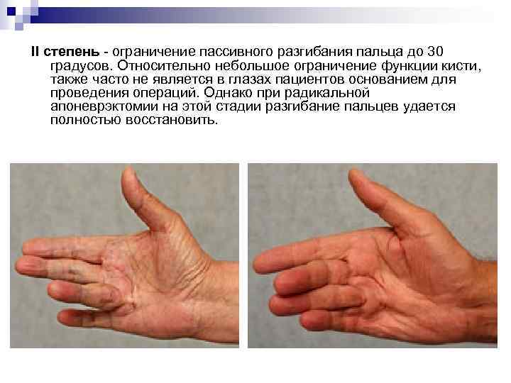 II степень - ограничение пассивного разгибания пальца до 30 градусов. Относительно небольшое ограничение функции