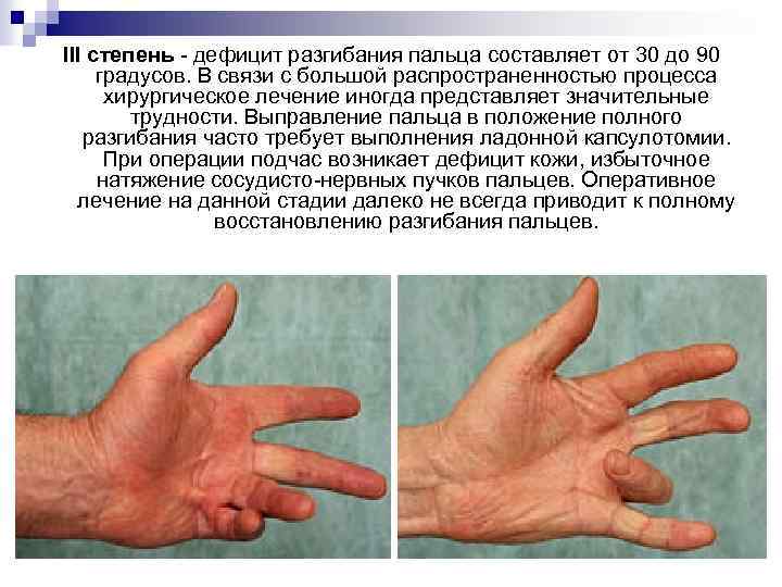 III степень - дефицит разгибания пальца составляет от 30 до 90 градусов. В связи