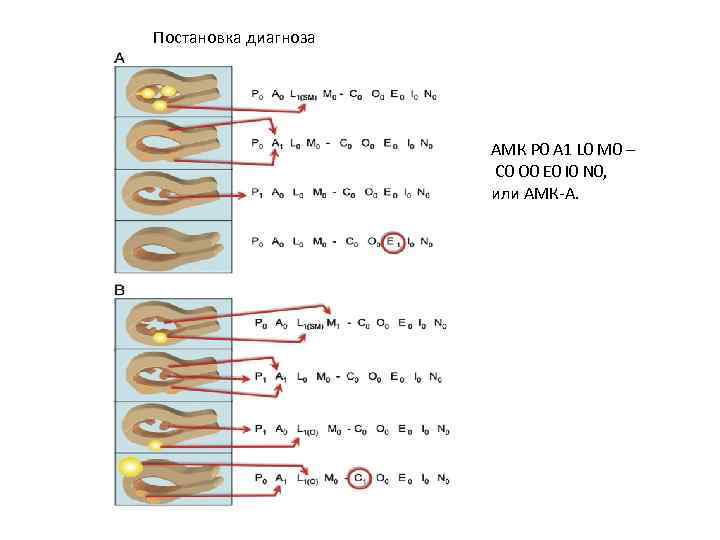Постановка диагноза АМК P 0 A 1 L 0 M 0 – C 0