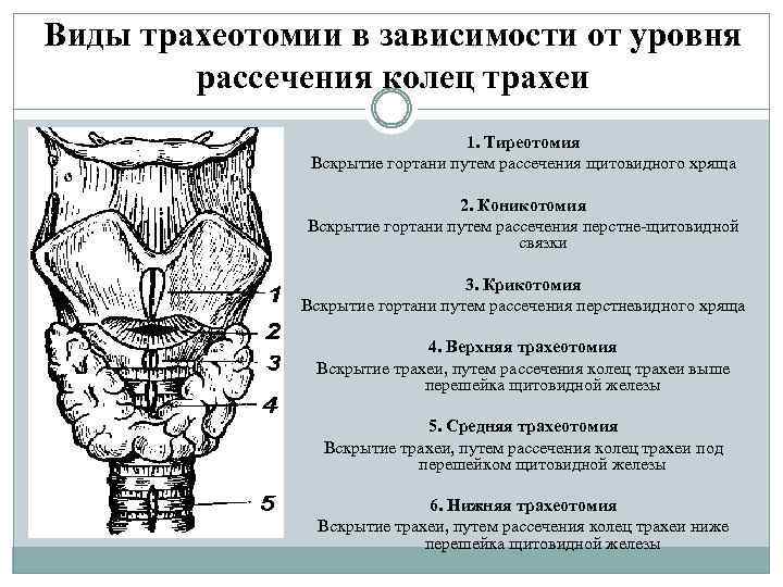 Виды трахеотомии в зависимости от уровня рассечения колец трахеи 1. Тиреотомия Вскрытие гортани путем